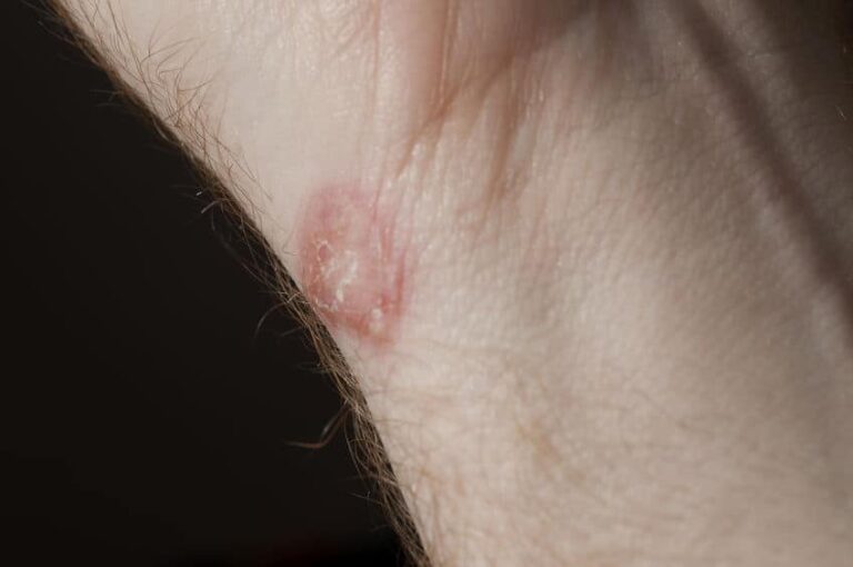 Top Seven Ways To Avoid Ringworm In BJJ and Wrestling